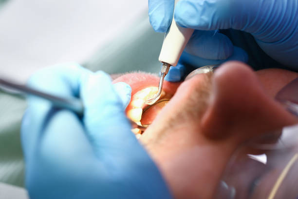 Best Emergency Root Canal Treatment in Elgin, TX